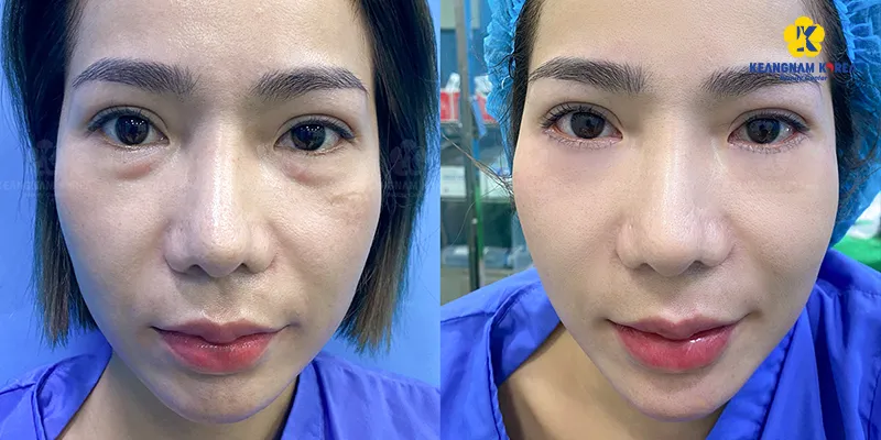 Cách xử lý bọng mắt dưới