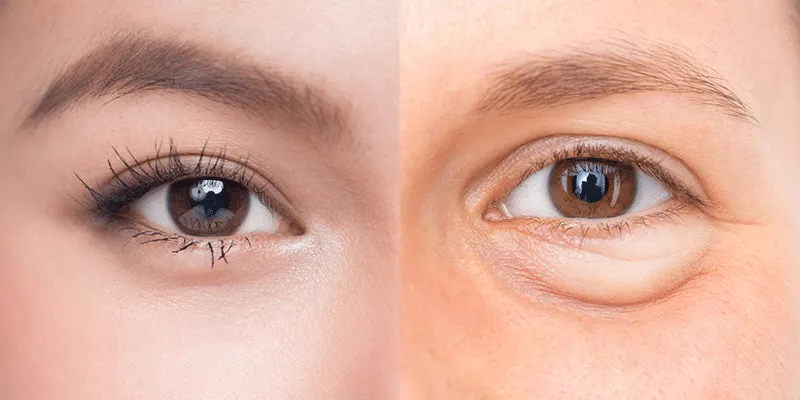 lấy bọng mắt dưới