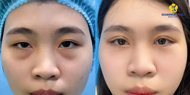 Cách trị bọng mắt dưới