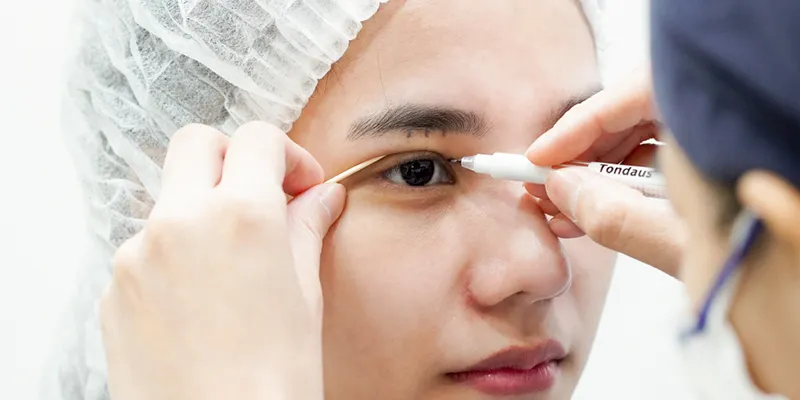 Căng chỉ nâng cung mày là gì