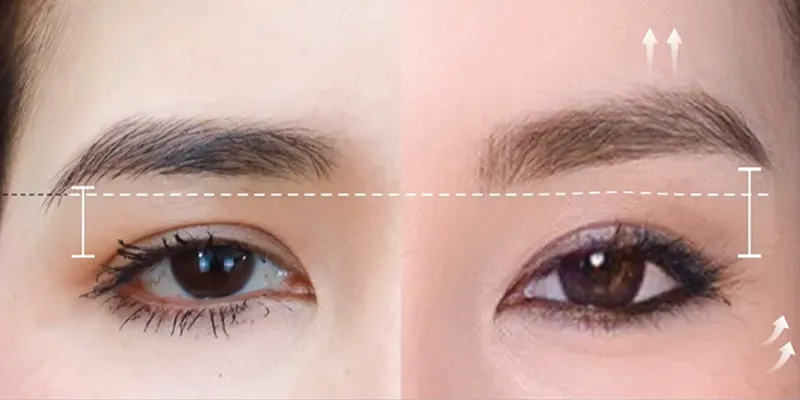 Căng chỉ nâng cung mày là gì