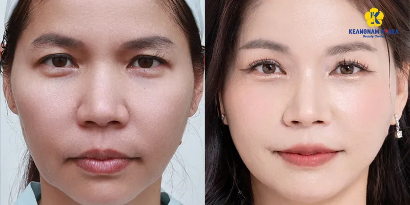 Căng chỉ nâng cung mày là gì