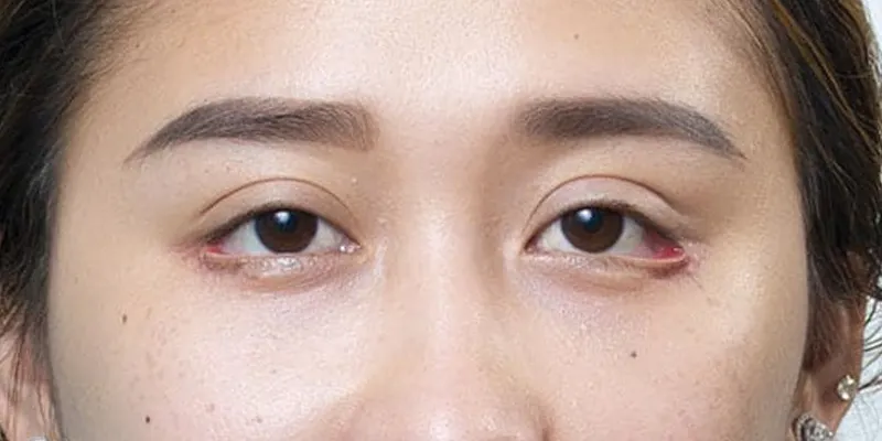 Cắt mắt bị lật mí trên