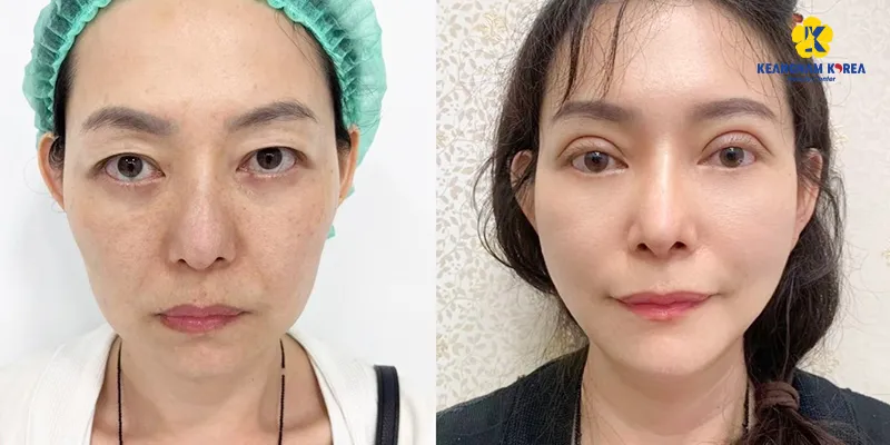 Cắt mí dưới có hết thâm mắt không