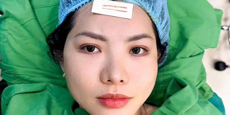 Cắt mí dưới xóa rãnh lệ