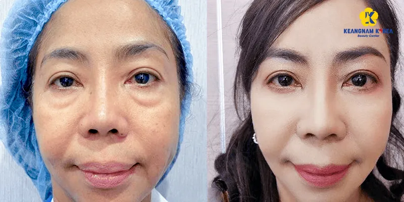 Cắt mí dưới xóa rãnh lệ