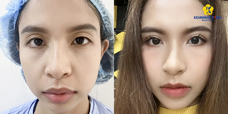 Cắt mí quá to có sửa được không