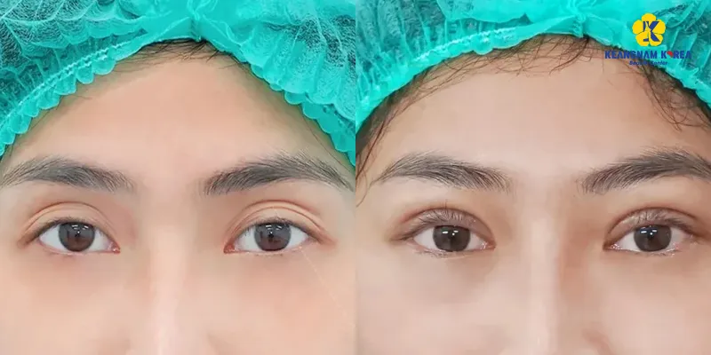 Cắt mí quá to có sửa được không