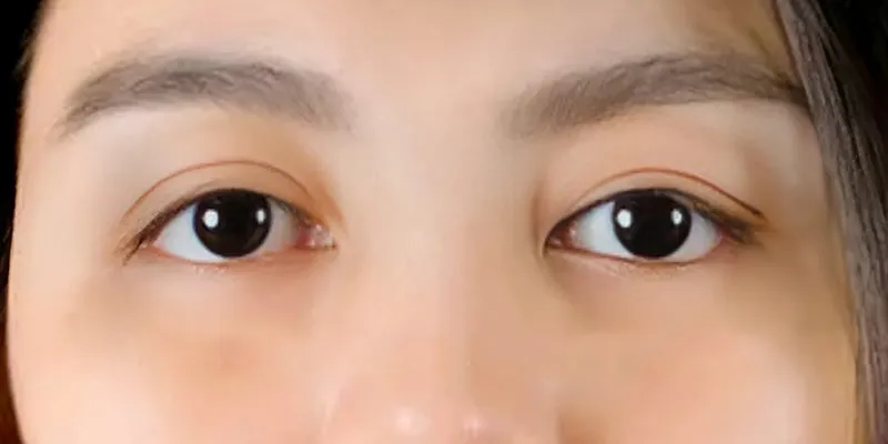 cắt mí quá to thì sao
