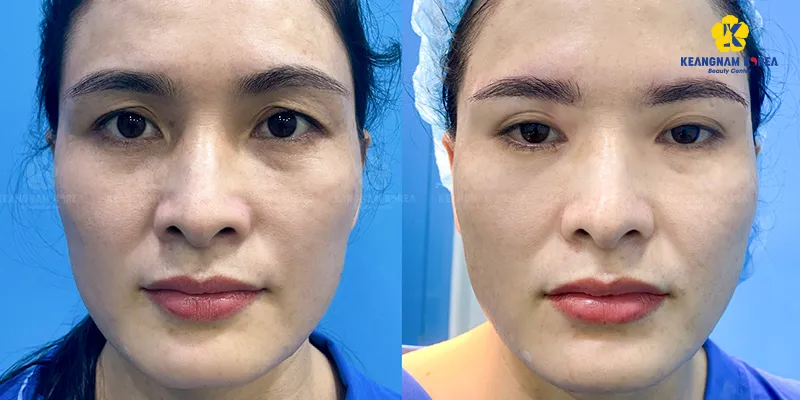 Hình ảnh treo cung chân mày thực tế