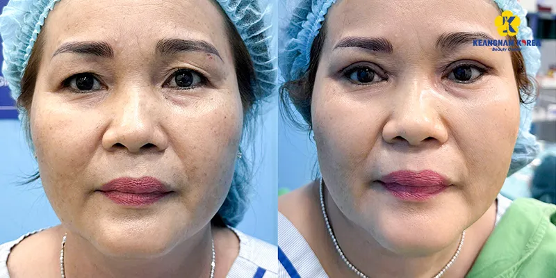 Hình ảnh treo cung chân mày thực tế