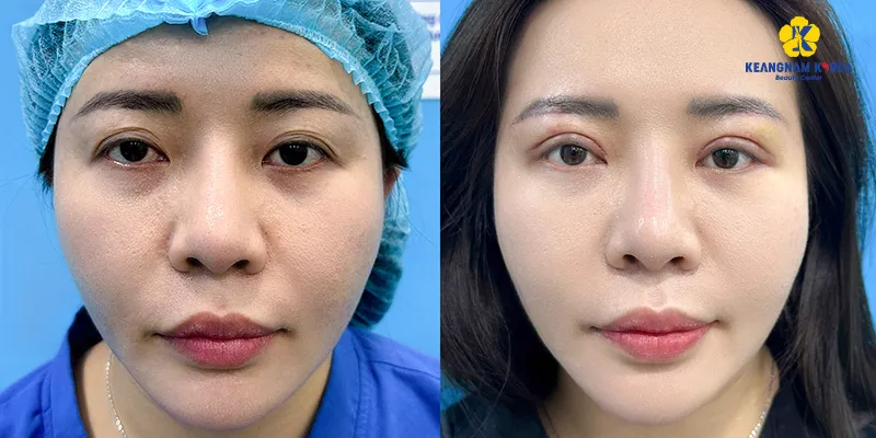 Hình ảnh treo cung chân mày thực tế