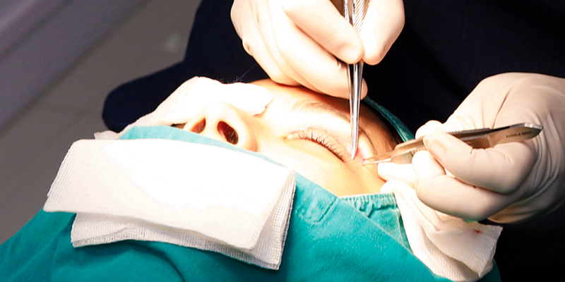What Is Korean Blepharoplasty? What Does It Cost in Ho Chi Minh City, Vietnam? 2 korean blepharoplasty