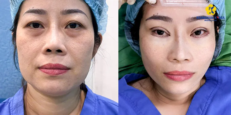 Lấy mỡ bọng mắt bao lâu thì lành