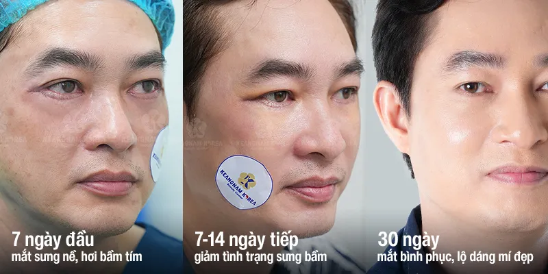 cắt mỡ bọng mắt