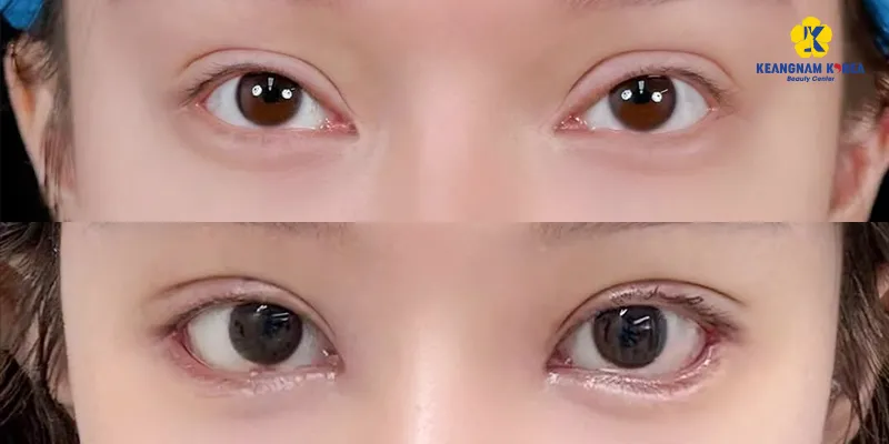 Mở góc mắt giọt lệ Trung Hoa là gì