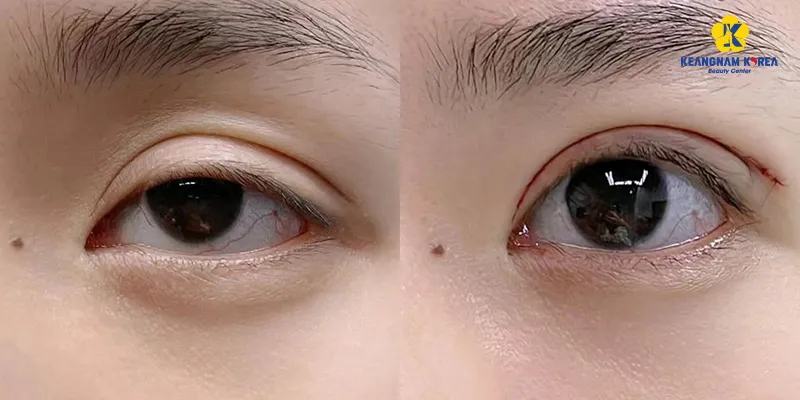 Mở góc mắt giọt lệ Trung Hoa là gì
