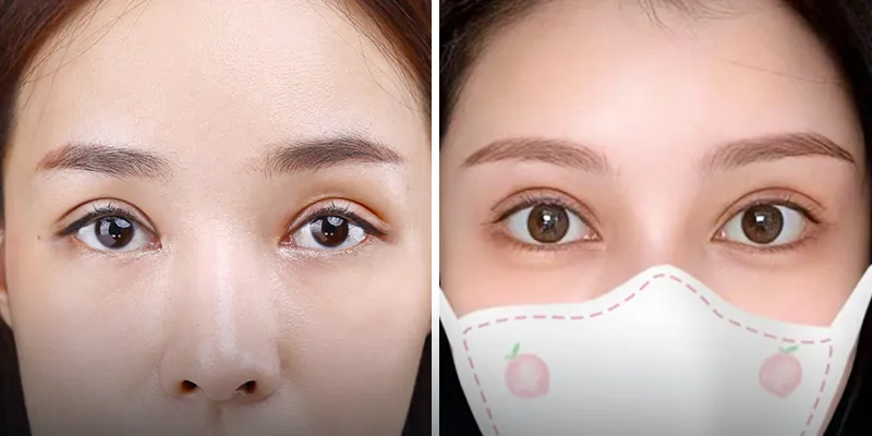 Mở góc mắt giọt lệ Trung Hoa là gì
