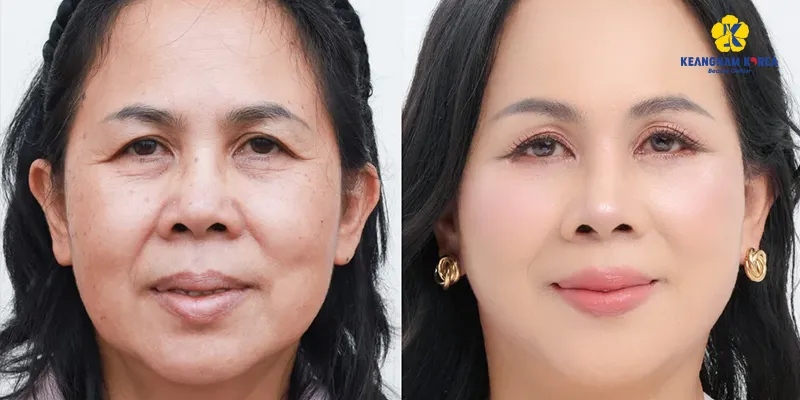 Treo chân mày nội soi giá bao nhiêu