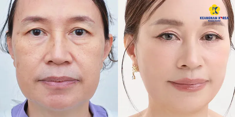 Treo chân mày nội soi giá bao nhiêu