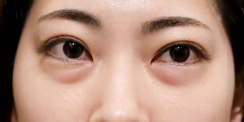 Bọng mắt dưới to nguyên nhân là gì