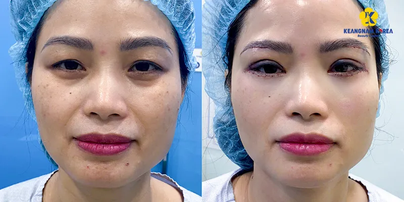 xử lý Bọng mắt dưới to