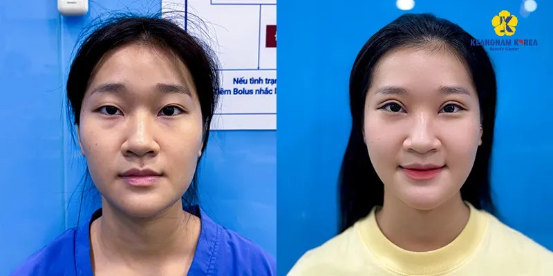 4 phương pháp cắt mí hiện đại nhất hiện nay  