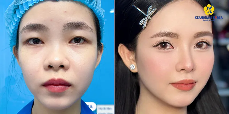 Các loại mí mắt đẹp