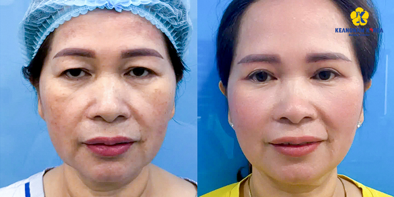 cắt mí mắt cho người già