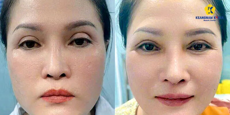 Cắt mí rồi có cắt lại được không