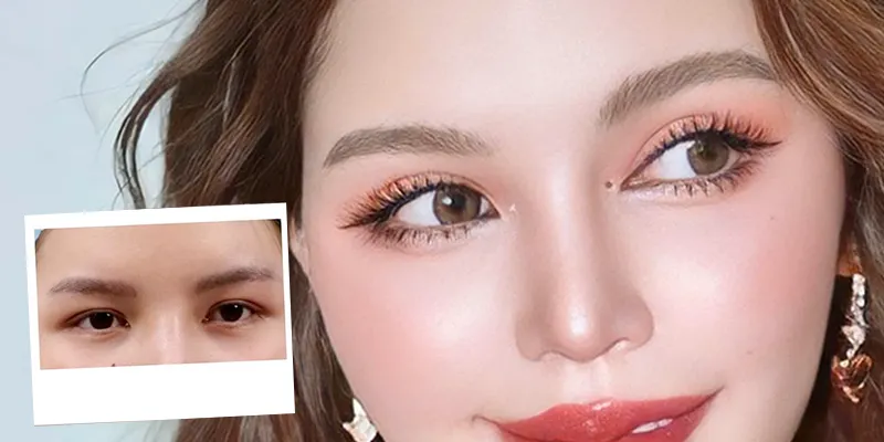 Cắt mí rồi có cắt lại được không