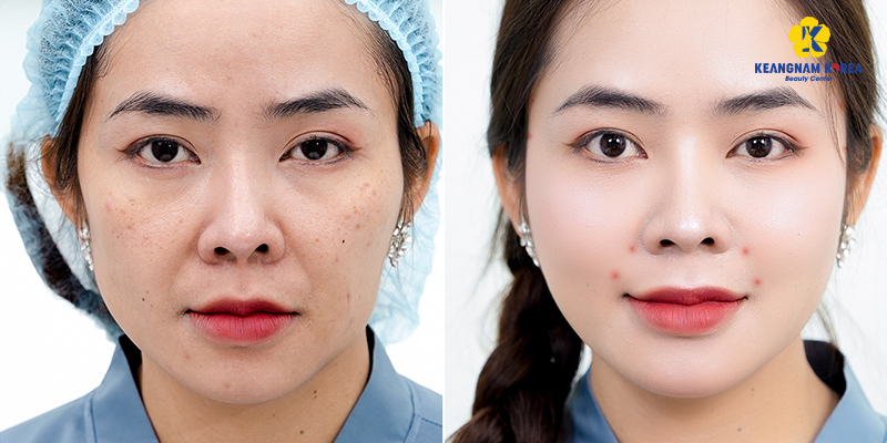 5 công nghệ chăm sóc da mới nhất