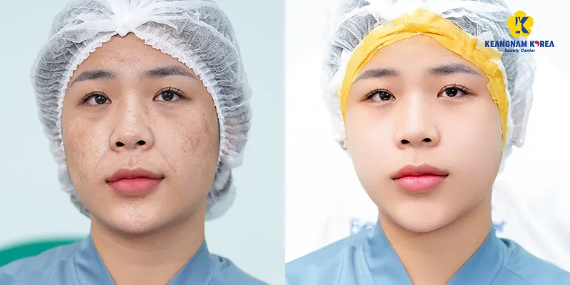 7 Công nghệ làm đẹp da mặt mới nhất hiện nay 