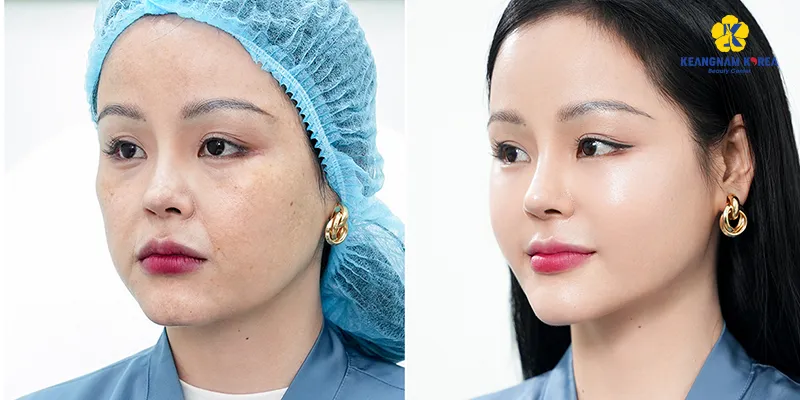 7 Công nghệ làm đẹp da mặt mới nhất hiện nay 