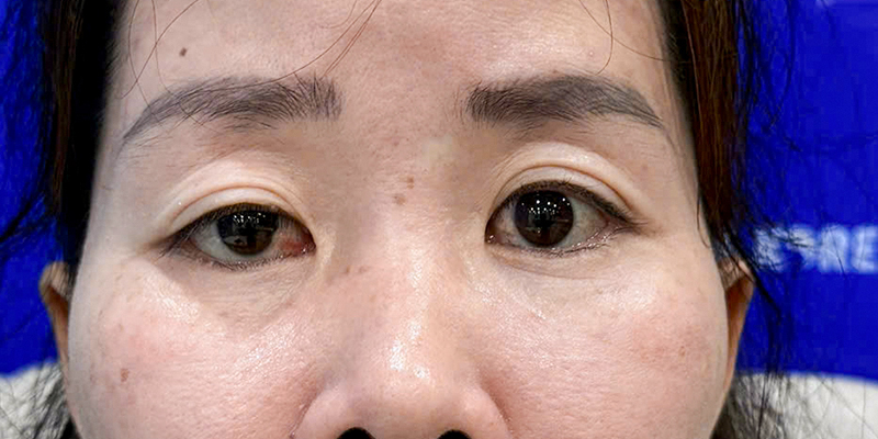 Hốc mắt sâu có nên cắt mí