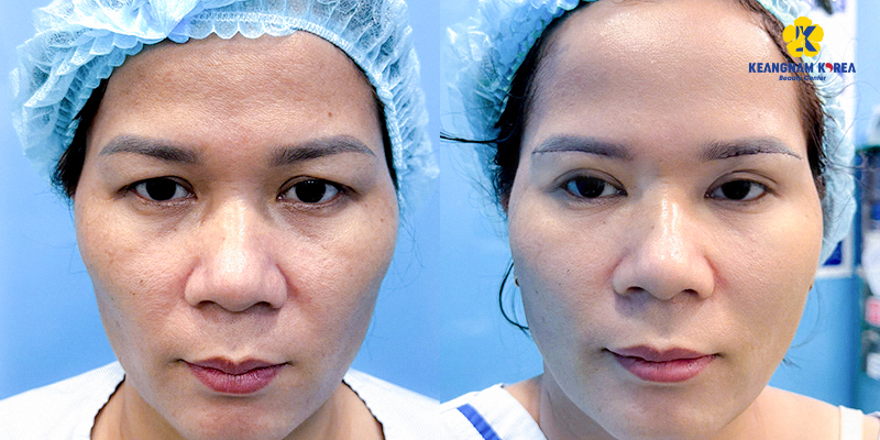 Hốc mắt sâu có nên cắt mí