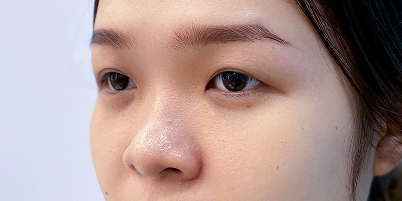 Mắt bị sụp sau khi cắt mí nguyên nhân là gì?