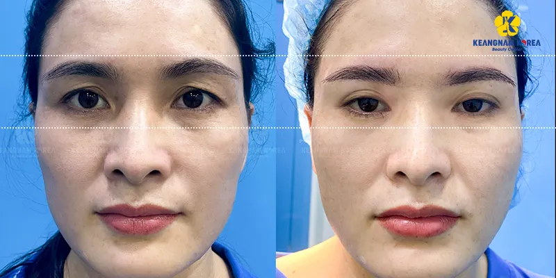 Nâng cung mày bao lâu thì hết sưng? 