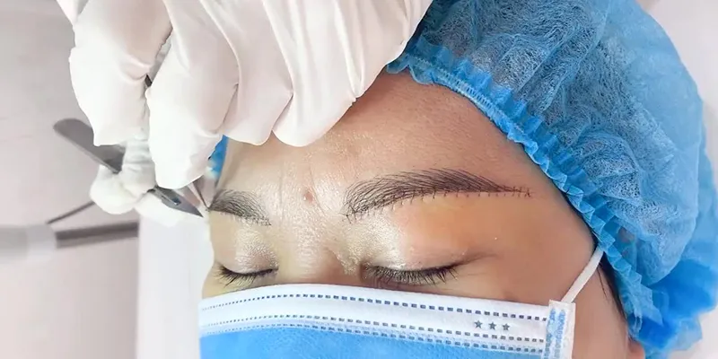 Nâng cung mày bao lâu thì hết sưng? 