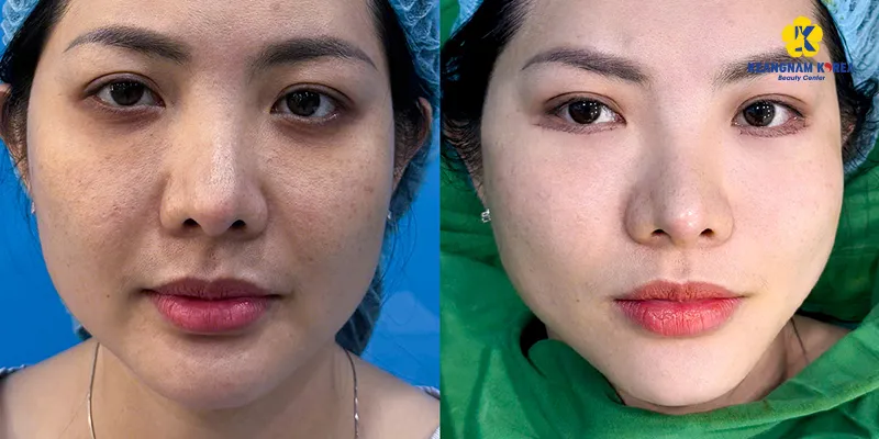 cách trị bọng mắt dưới hiệu quả