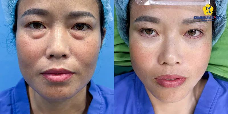 thẩm mỹ cắt bọng mắt dưới