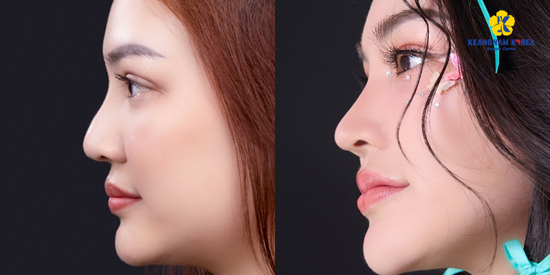 các kiểu sửa mũi cấu trúc