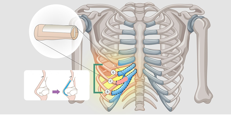 nâng mũi sườn sụn