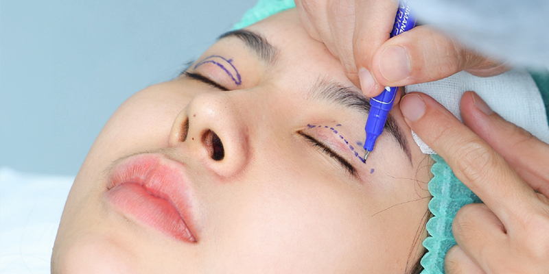 bóc mỡ bọng mắt trên
