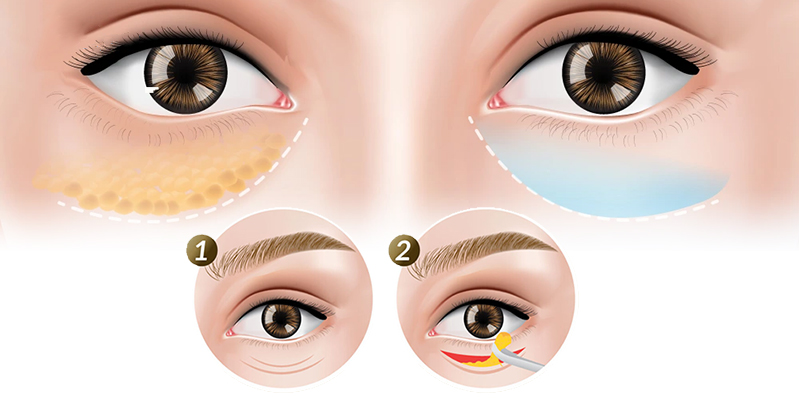 quy trình bóc mỡ mắt là gì?