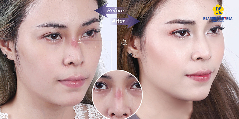 Sụn Softxil là gì