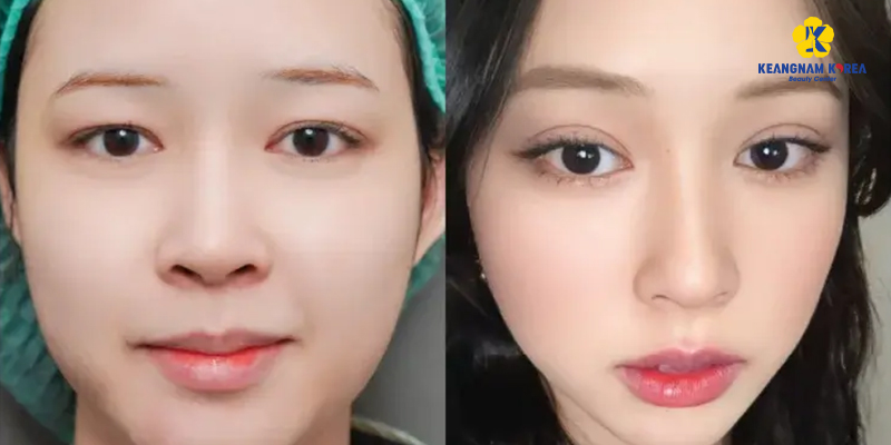 Bóc mỡ mắt ở đâu