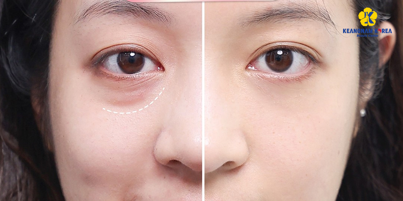 Bóc mỡ mắt là gì?