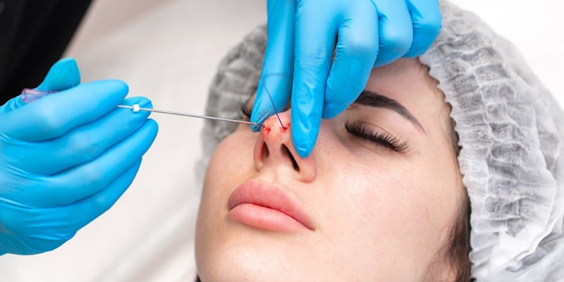 các kiểu nâng mũi thịnh hành nhất hiện nay
