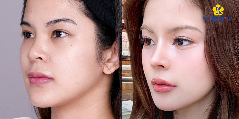 các kiểu sửa mũi bằng sụn tự thân